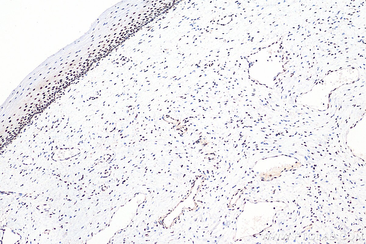 IHC staining of human cervical cancer using 27494-1-AP