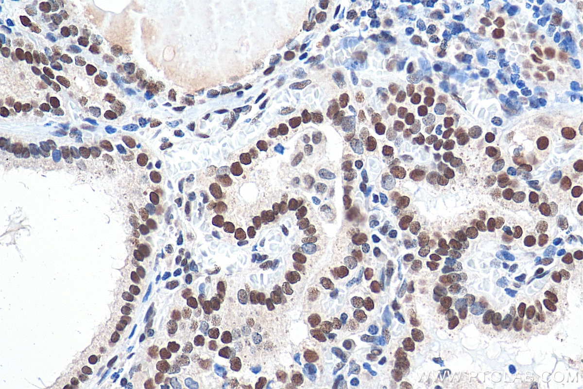 Immunohistochemistry (IHC) staining of human thyroid cancer tissue using GTF3C2 Polyclonal antibody (27494-1-AP)