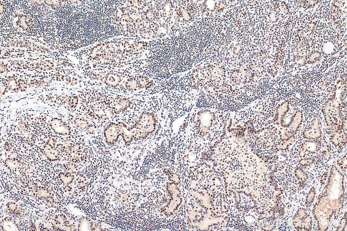 IHC staining of human thyroid cancer using 27494-1-AP