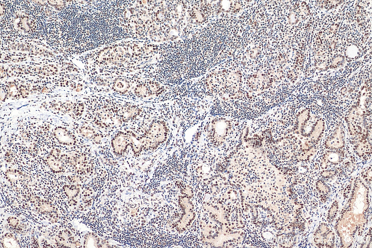 Immunohistochemistry (IHC) staining of human thyroid cancer tissue using GTF3C2 Polyclonal antibody (27494-1-AP)