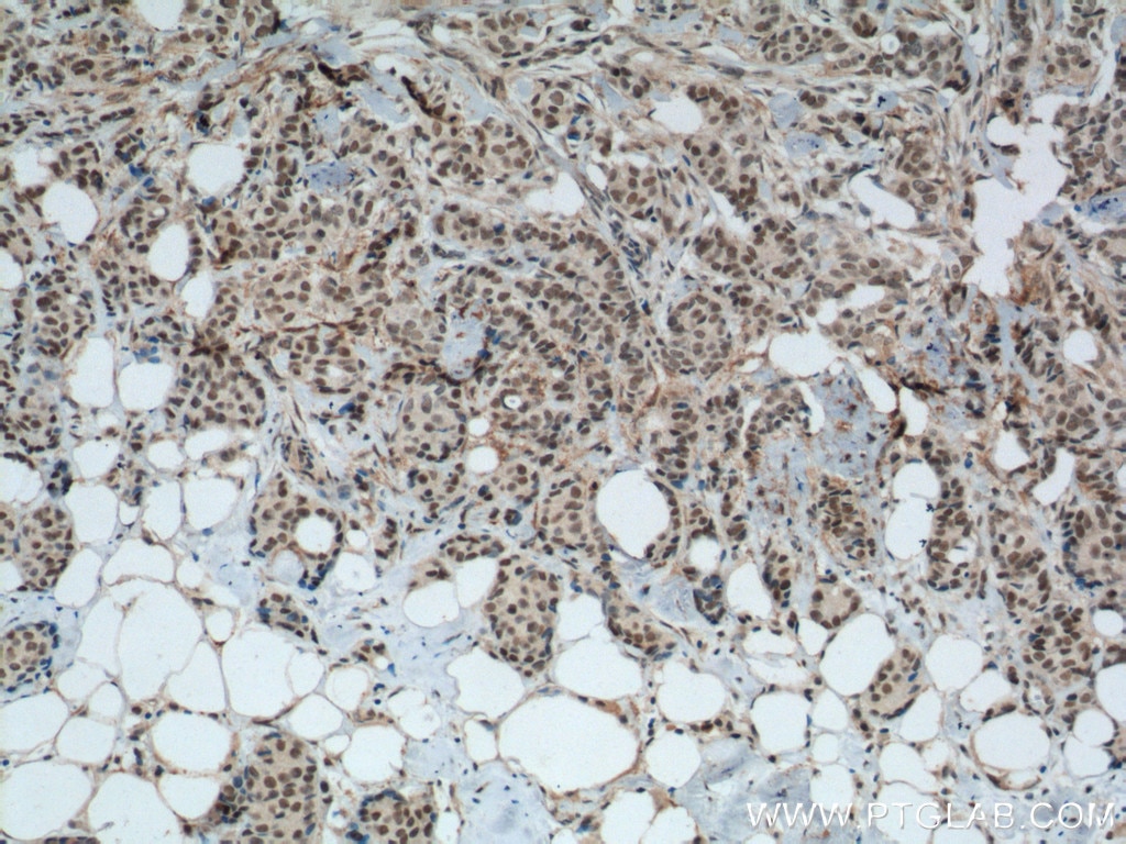 Immunohistochemistry (IHC) staining of human breast cancer tissue using GTF3C4 Polyclonal antibody (17653-1-AP)