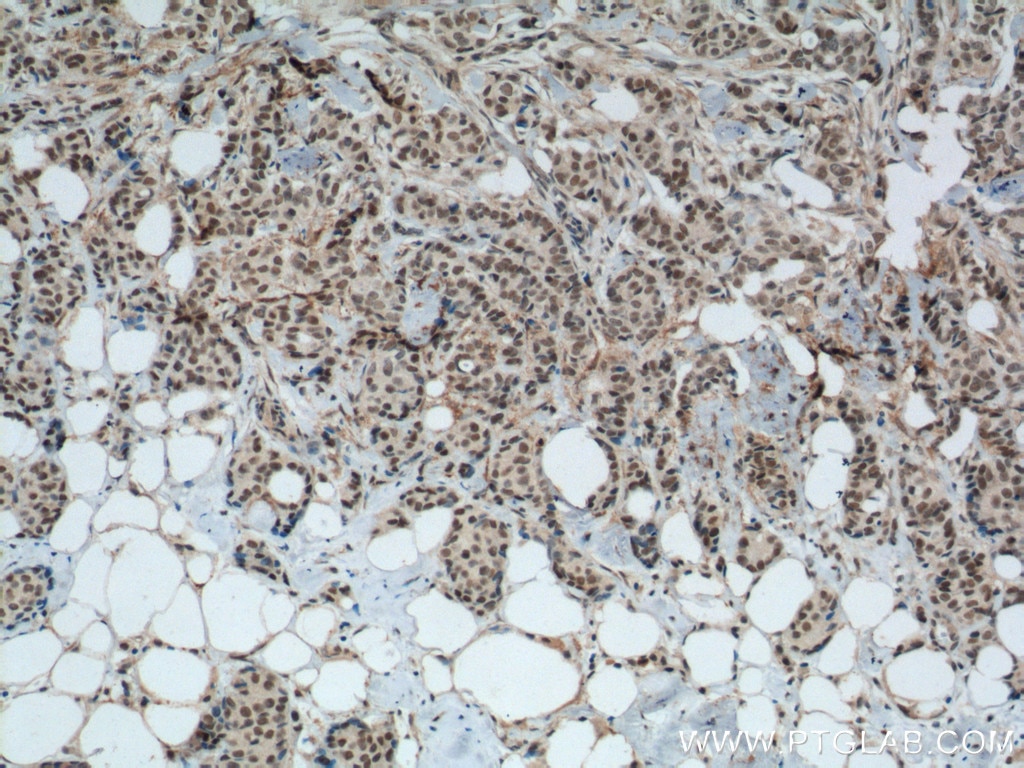 IHC staining of human breast cancer using 17653-1-AP