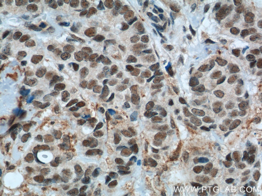 Immunohistochemistry (IHC) staining of human breast cancer tissue using GTF3C4 Polyclonal antibody (17653-1-AP)