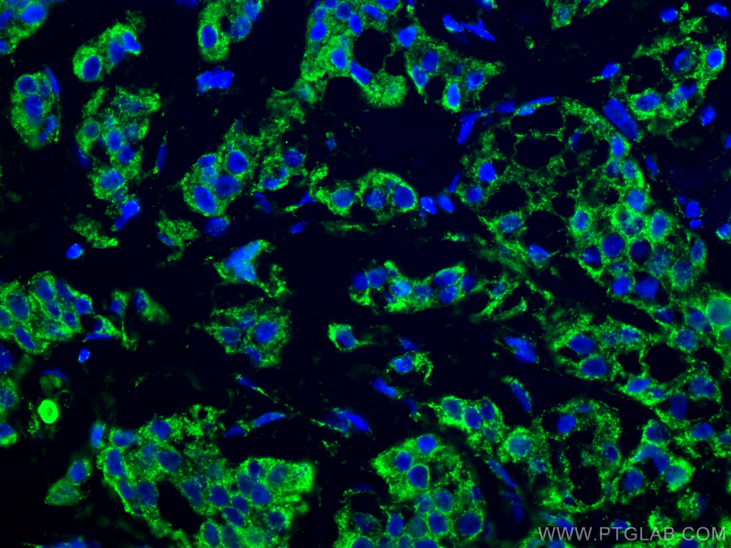 Immunofluorescence (IF) / fluorescent staining of human breast cancer tissue using GTPBP3 Polyclonal antibody (10764-1-AP)