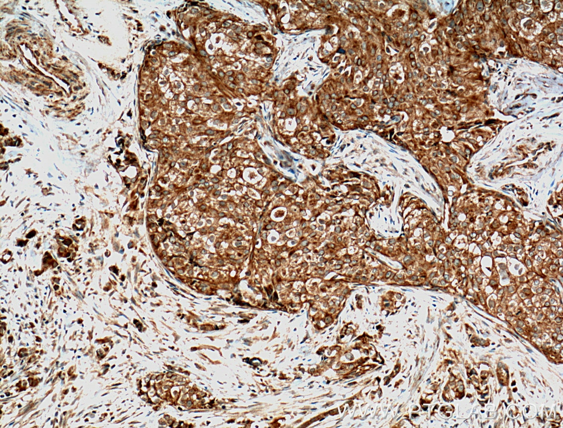 Immunohistochemistry (IHC) staining of human breast cancer tissue using GTPBP3 Polyclonal antibody (10764-1-AP)