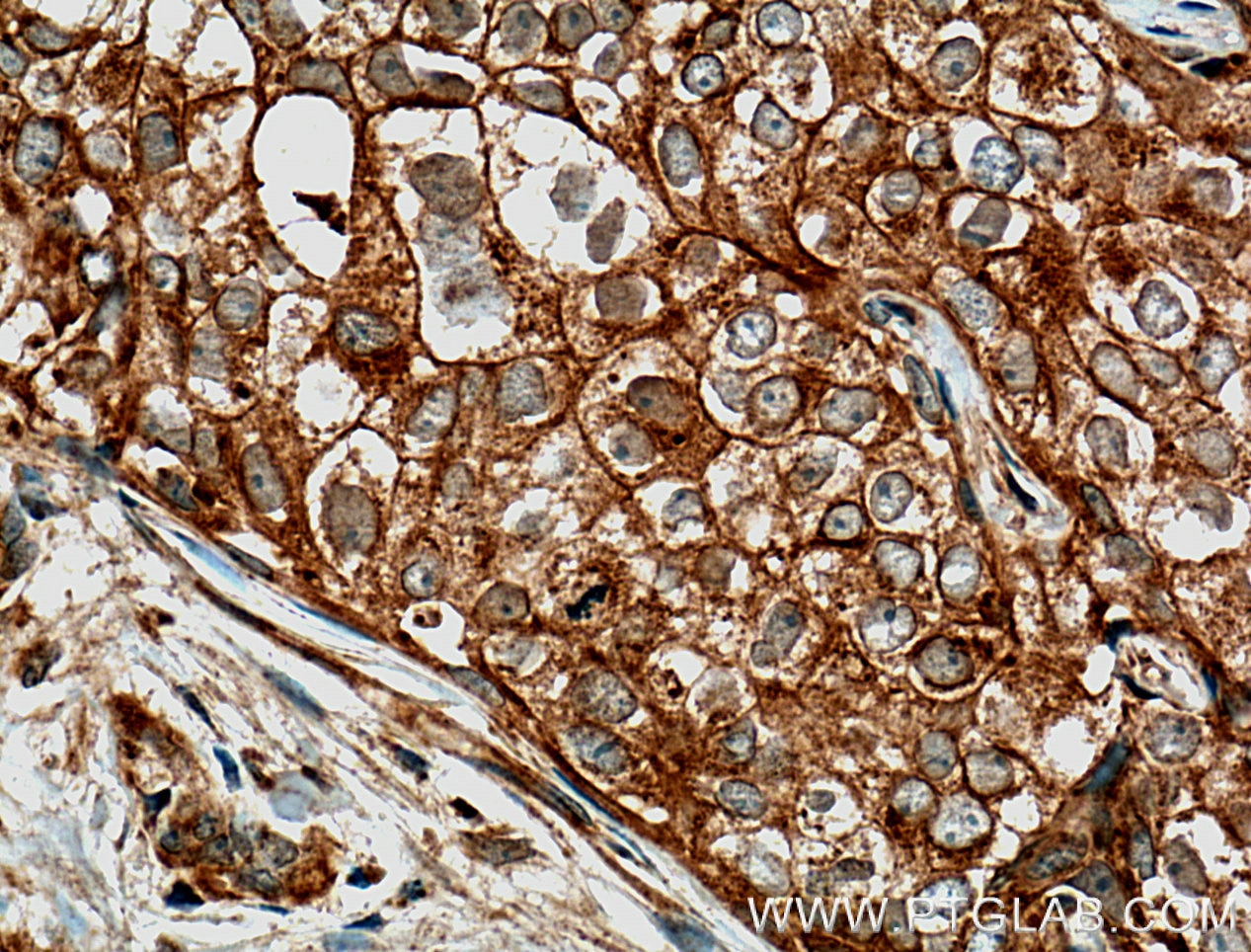 Immunohistochemistry (IHC) staining of human breast cancer tissue using GTPBP3 Polyclonal antibody (10764-1-AP)