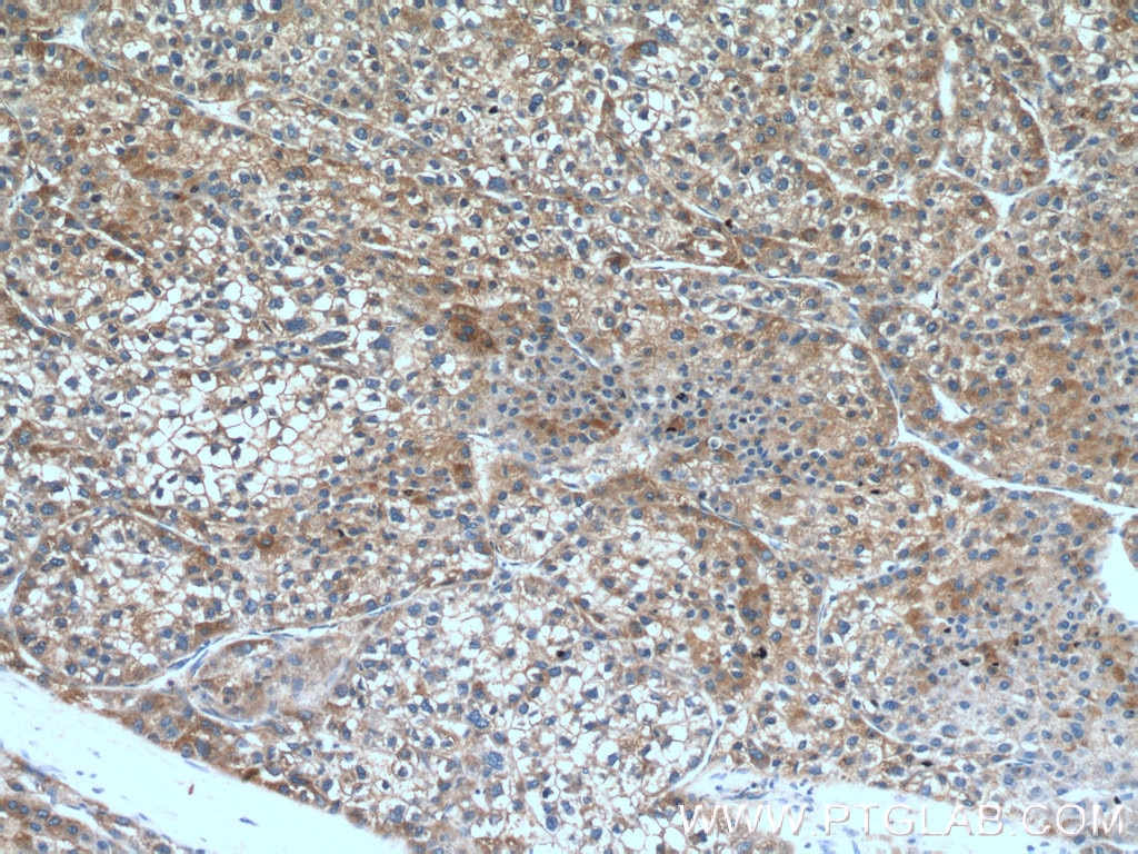 Immunohistochemistry (IHC) staining of human liver cancer tissue using GTSE1 Polyclonal antibody (21319-1-AP)