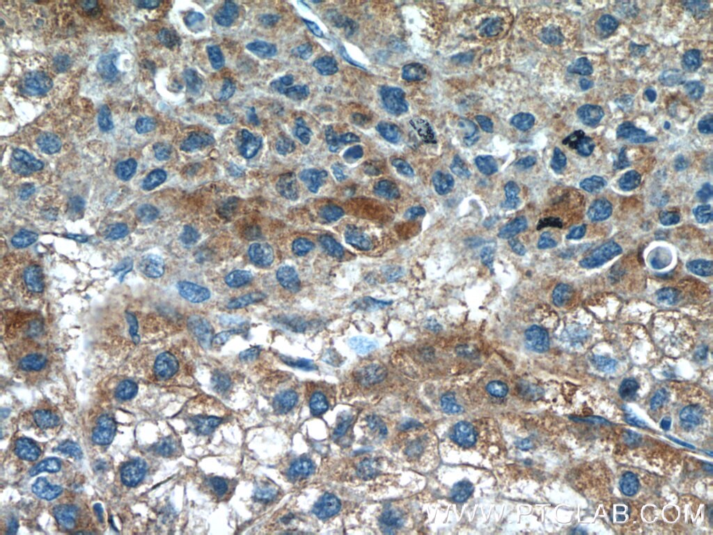 Immunohistochemistry (IHC) staining of human liver cancer tissue using GTSE1 Polyclonal antibody (21319-1-AP)