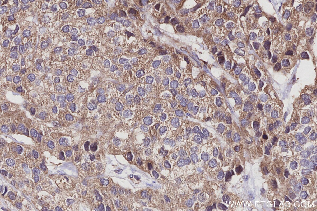 Immunohistochemistry (IHC) staining of human stomach cancer tissue using GTSE1 Polyclonal antibody (21319-1-AP)