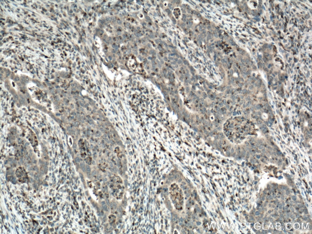 Immunohistochemistry (IHC) staining of human colon cancer tissue using Uroguanylin Polyclonal antibody (18113-1-AP)