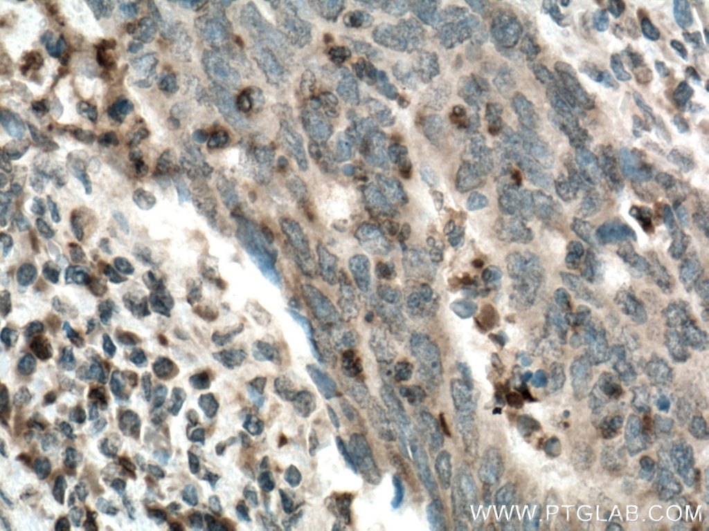 Immunohistochemistry (IHC) staining of human colon cancer tissue using Uroguanylin Polyclonal antibody (18113-1-AP)