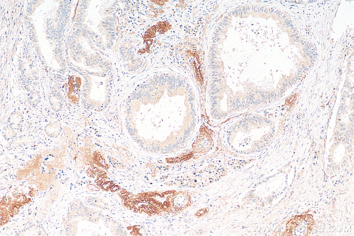 Immunohistochemistry (IHC) staining of human pancreas cancer tissue using Uroguanylin Polyclonal antibody (18113-1-AP)