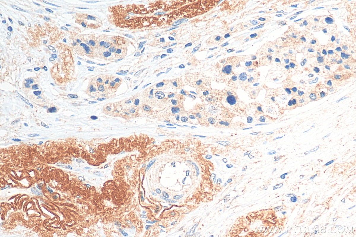 Immunohistochemistry (IHC) staining of human pancreas cancer tissue using Uroguanylin Polyclonal antibody (18113-1-AP)