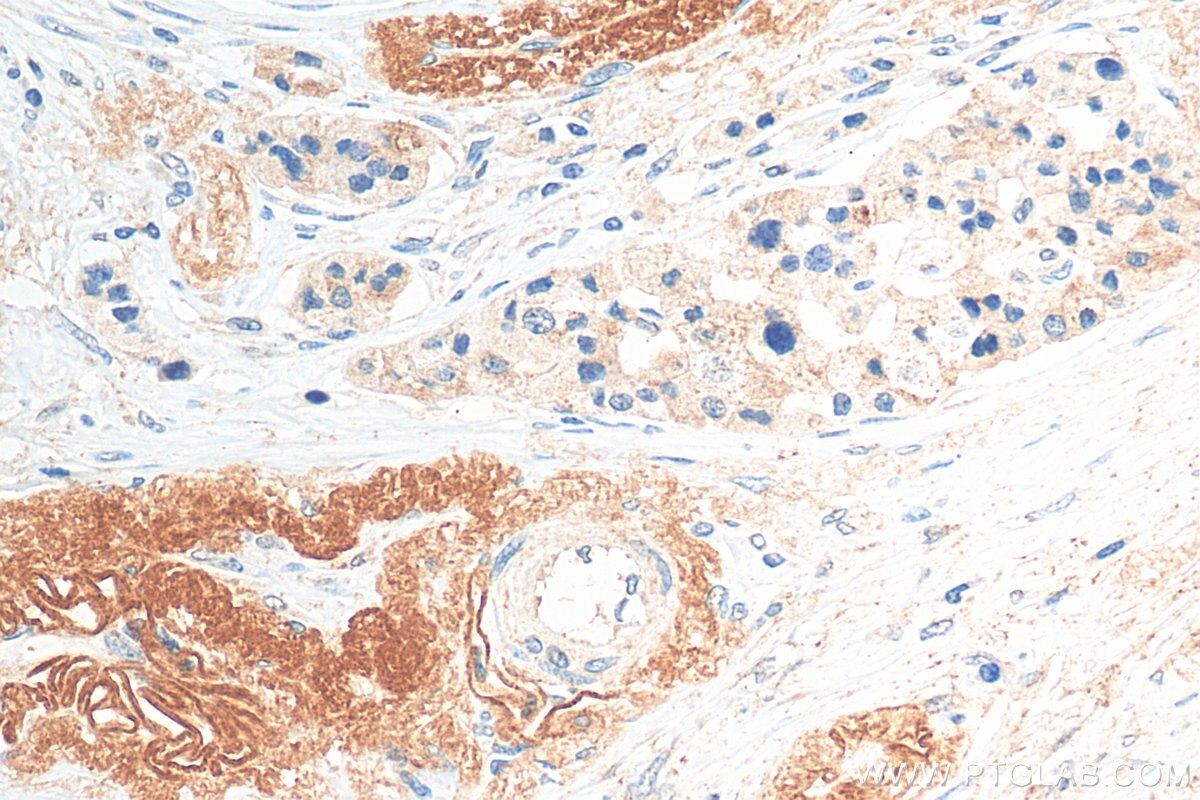 IHC staining of human pancreas cancer using 18113-1-AP