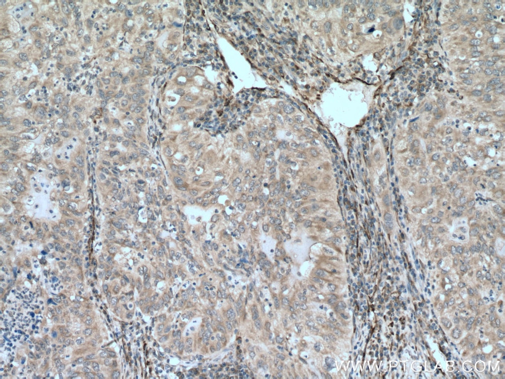 Immunohistochemistry (IHC) staining of human lung cancer tissue using GUCY1B3 Polyclonal antibody (19011-1-AP)