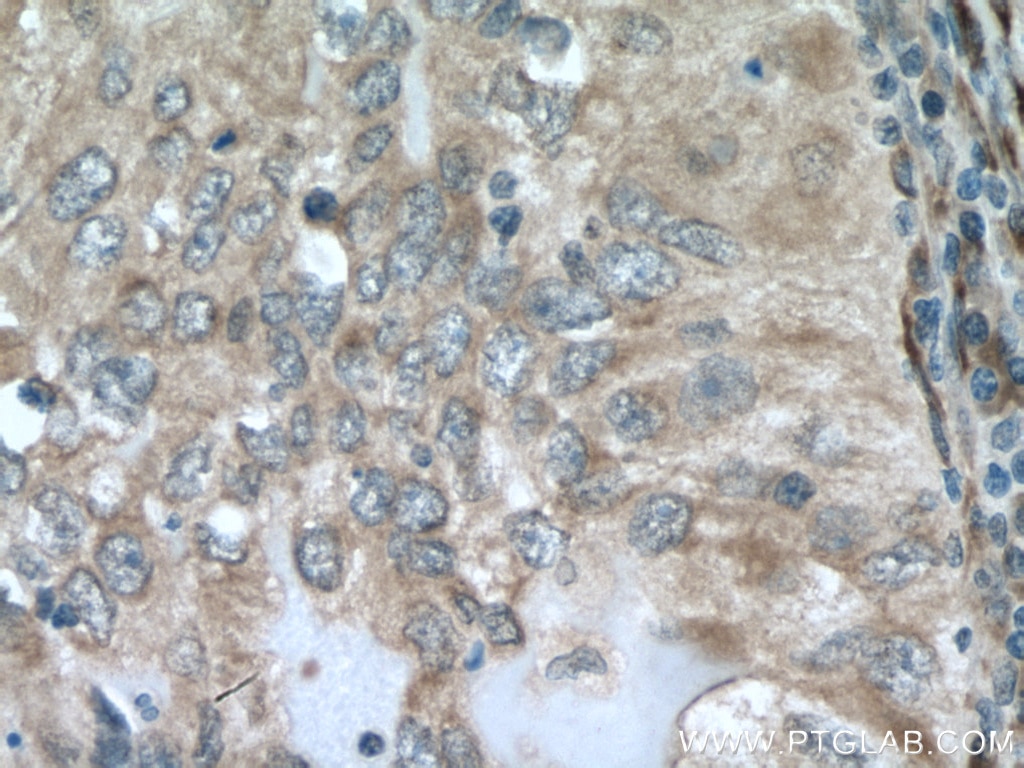 Immunohistochemistry (IHC) staining of human lung cancer tissue using GUCY1B3 Polyclonal antibody (19011-1-AP)
