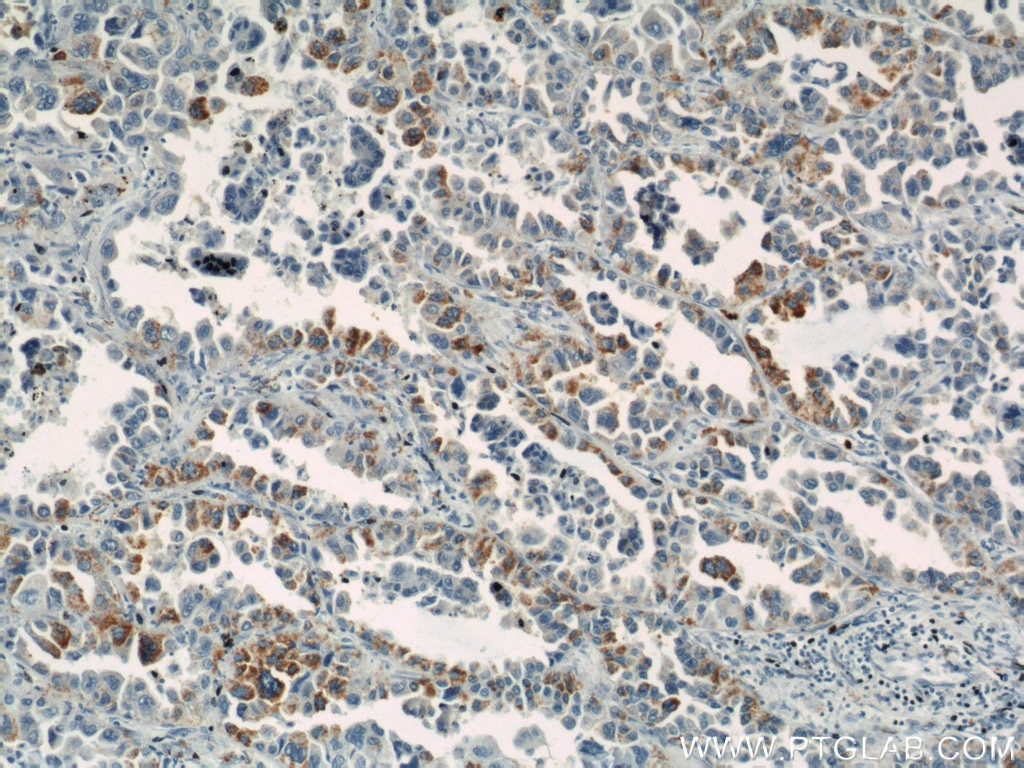 Immunohistochemistry (IHC) staining of human lung cancer tissue using GUF1 Polyclonal antibody (17489-1-AP)