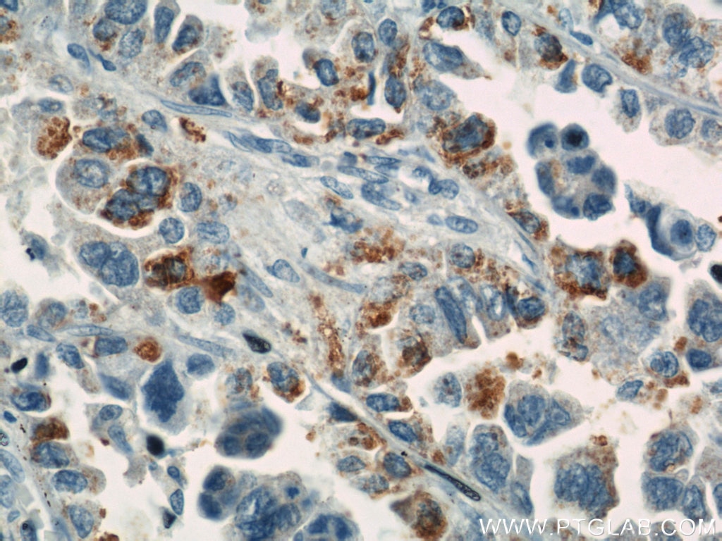 Immunohistochemistry (IHC) staining of human lung cancer tissue using GUF1 Polyclonal antibody (17489-1-AP)