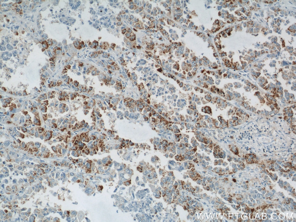 Immunohistochemistry (IHC) staining of human lung cancer tissue using GUF1 Polyclonal antibody (17489-1-AP)