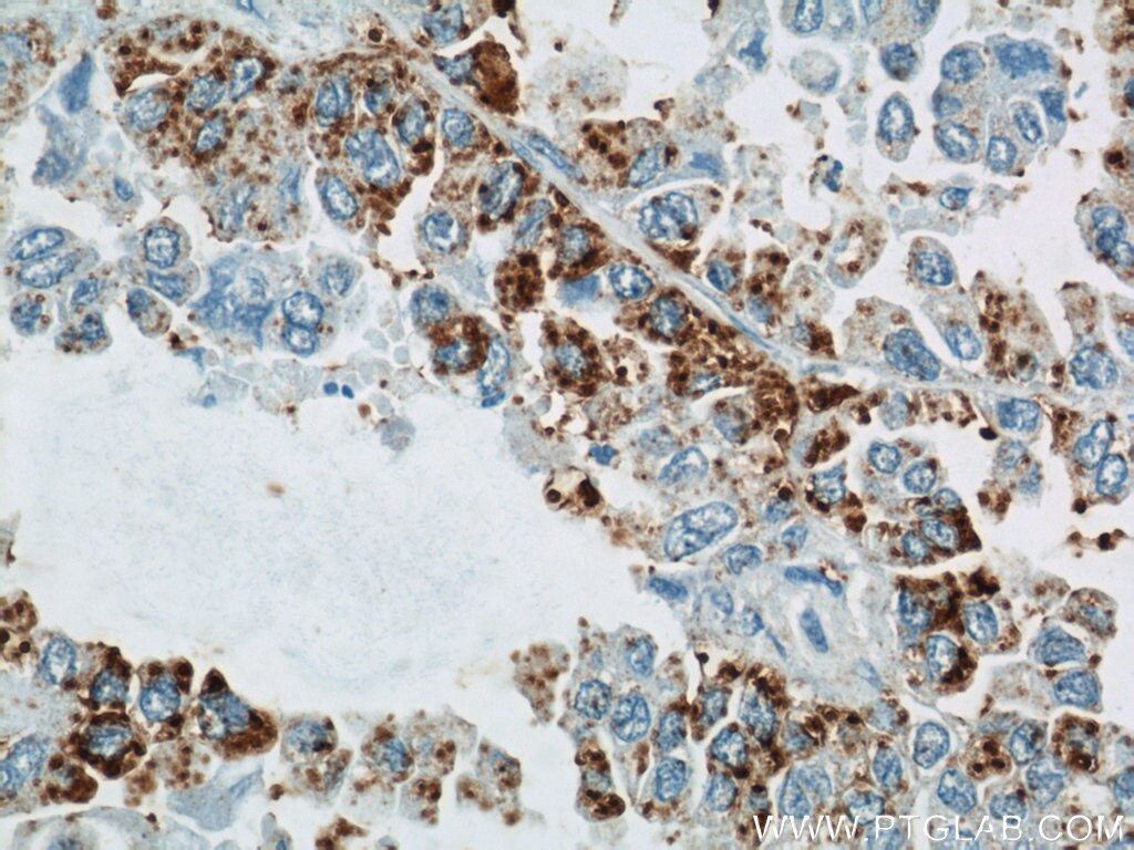 Immunohistochemistry (IHC) staining of human lung cancer tissue using GUF1 Polyclonal antibody (17489-1-AP)