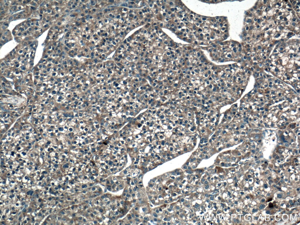 Immunohistochemistry (IHC) staining of human liver cancer tissue using GUK1 Polyclonal antibody (10755-1-AP)