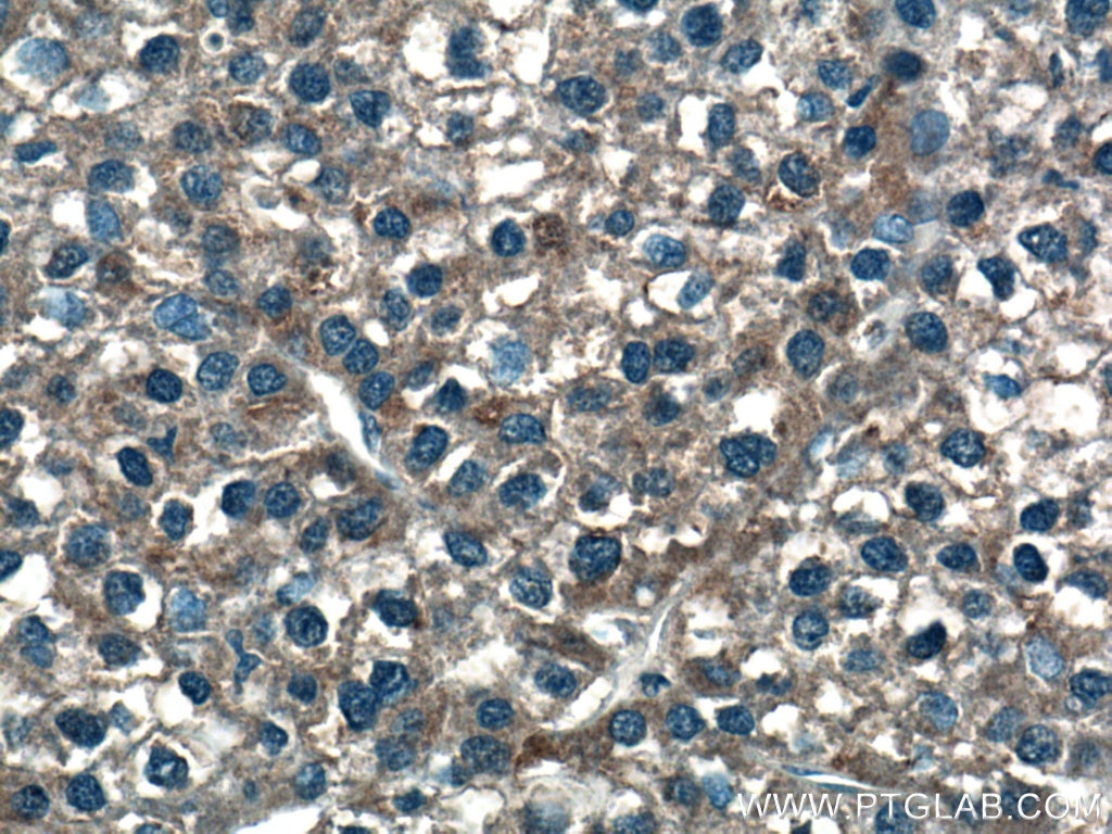 Immunohistochemistry (IHC) staining of human liver cancer tissue using GUK1 Polyclonal antibody (10755-1-AP)