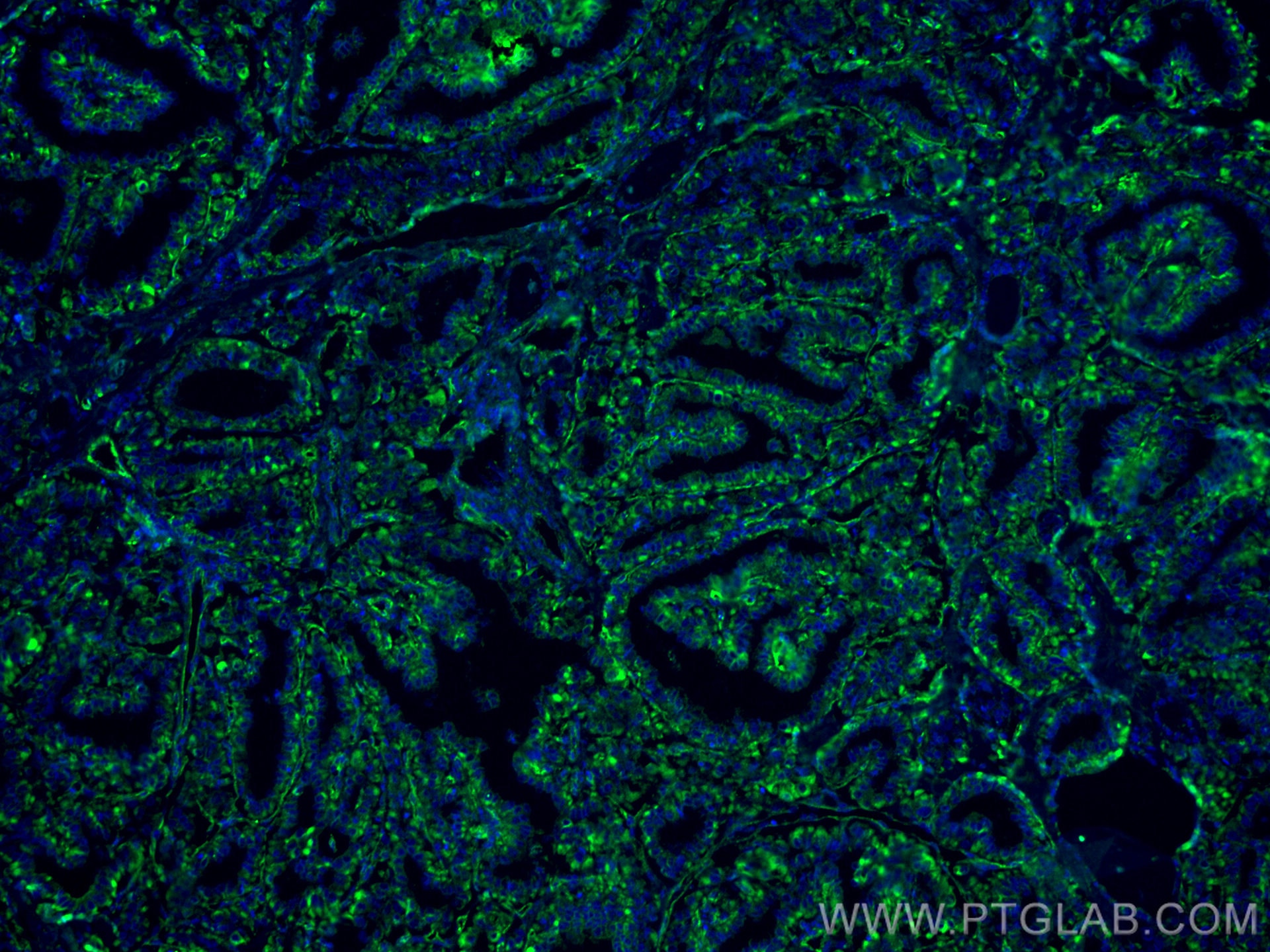 Immunofluorescence (IF) / fluorescent staining of human thyroid cancer tissue using GUK1 Monoclonal antibody (67047-1-Ig)