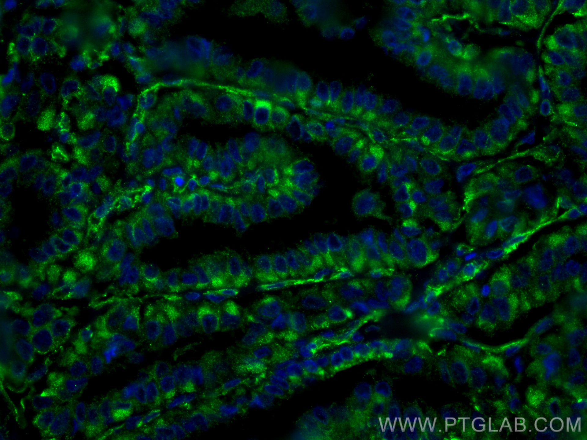 Immunofluorescence (IF) / fluorescent staining of human thyroid cancer tissue using GUK1 Monoclonal antibody (67047-1-Ig)
