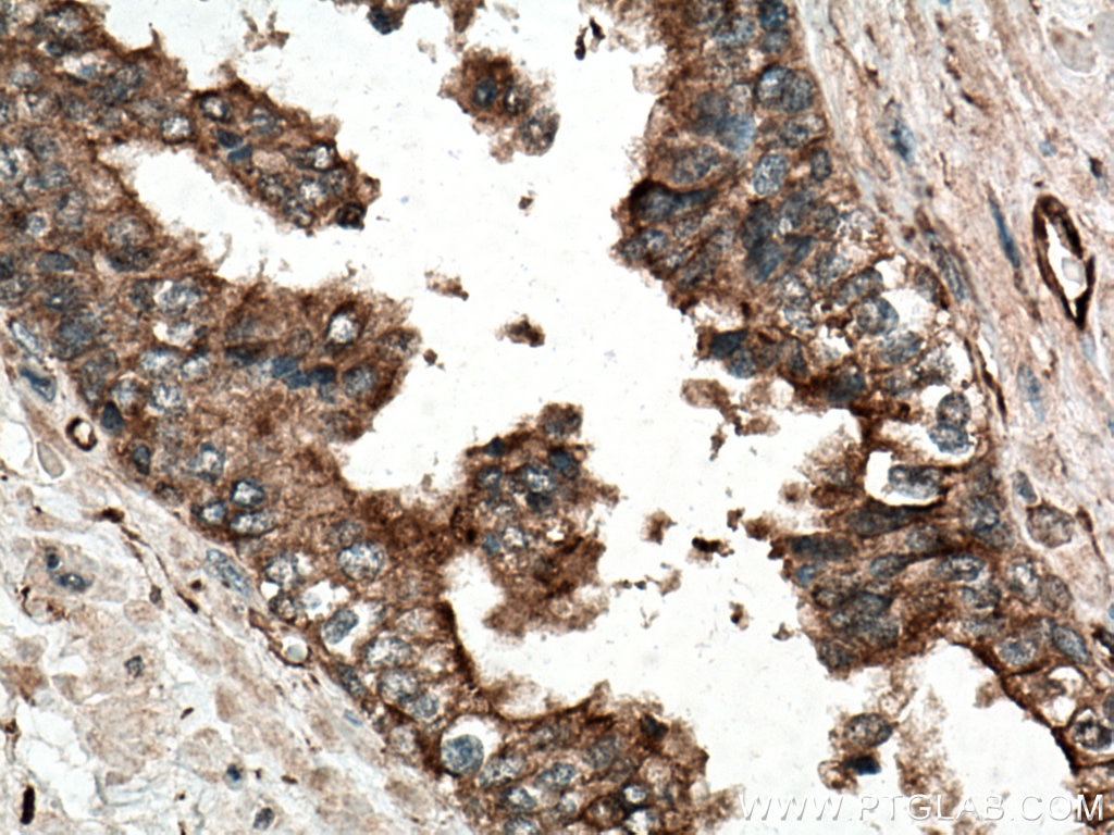IHC staining of human prostate cancer using 67047-1-Ig