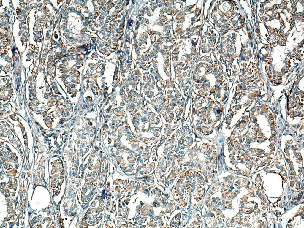 Immunohistochemistry (IHC) staining of human thyroid cancer tissue using GUK1 Monoclonal antibody (67047-1-Ig)