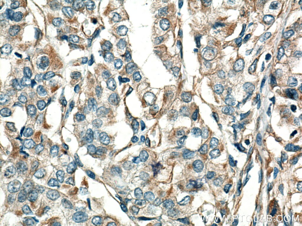 Immunohistochemistry (IHC) staining of human thyroid cancer tissue using GUK1 Monoclonal antibody (67047-1-Ig)
