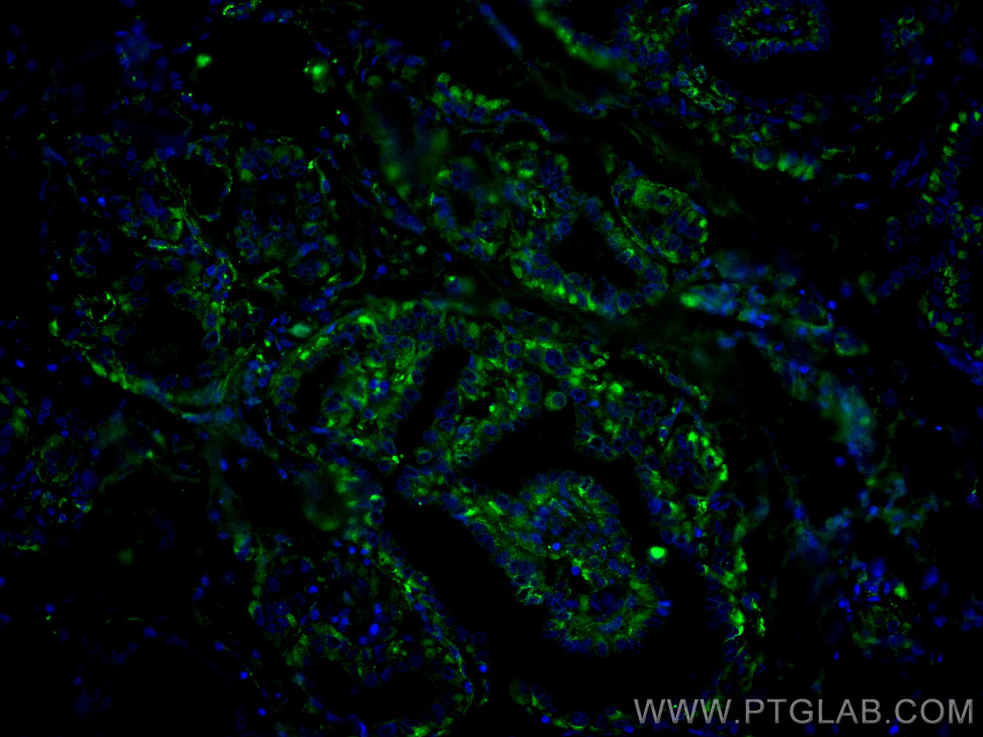 Immunofluorescence (IF) / fluorescent staining of human thyroid cancer tissue using CoraLite® Plus 488-conjugated GUK1 Monoclonal anti (CL488-67047)