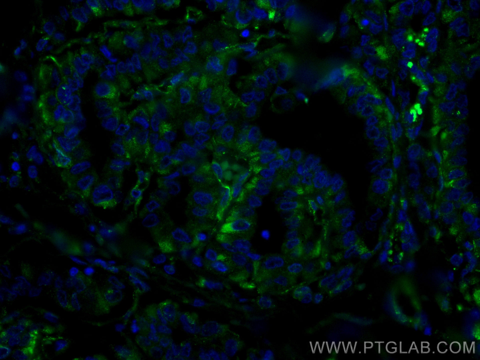 Immunofluorescence (IF) / fluorescent staining of human thyroid cancer tissue using CoraLite® Plus 488-conjugated GUK1 Monoclonal anti (CL488-67047)