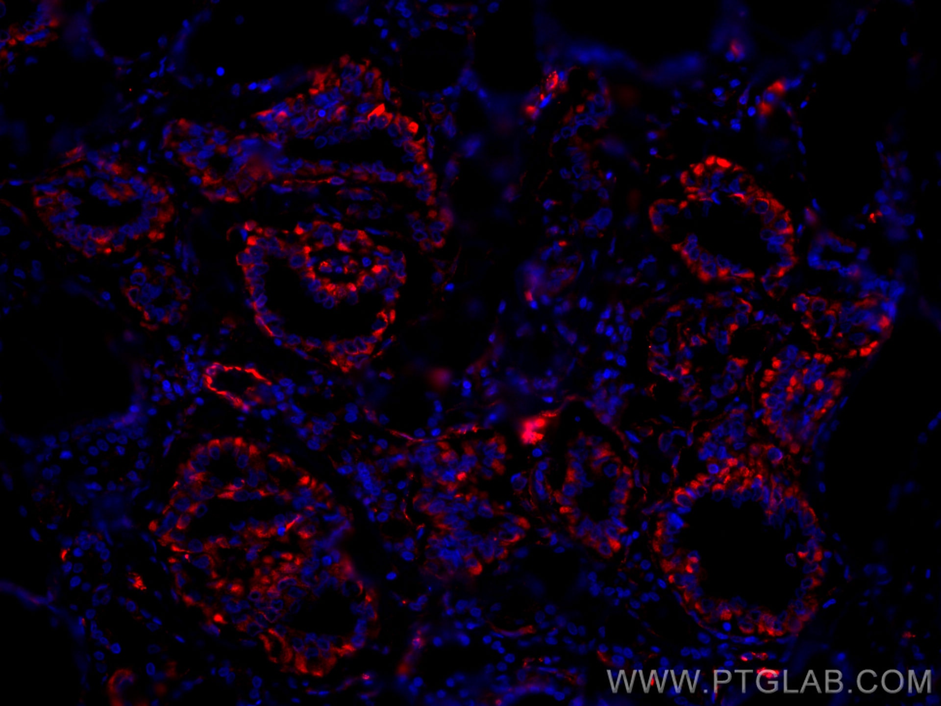 Immunofluorescence (IF) / fluorescent staining of human thyroid cancer tissue using CoraLite®594-conjugated GUK1 Monoclonal antibody (CL594-67047)