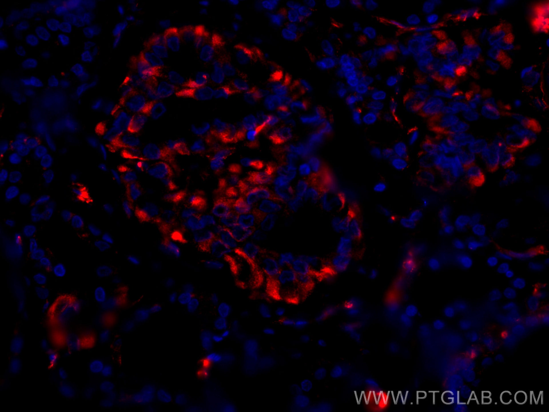 Immunofluorescence (IF) / fluorescent staining of human thyroid cancer tissue using CoraLite®594-conjugated GUK1 Monoclonal antibody (CL594-67047)