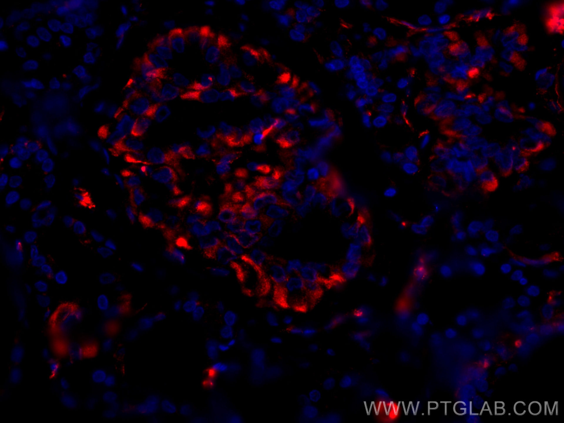 Immunofluorescence (IF) / fluorescent staining of human thyroid cancer tissue using CoraLite®594-conjugated GUK1 Monoclonal antibody (CL594-67047)