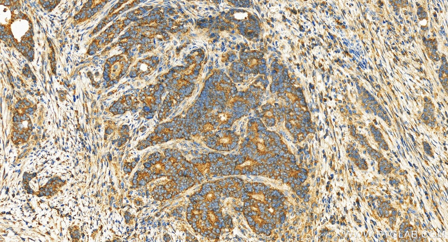 Immunohistochemistry (IHC) staining of human stomach cancer tissue using GULP1 Polyclonal antibody (19902-1-AP)
