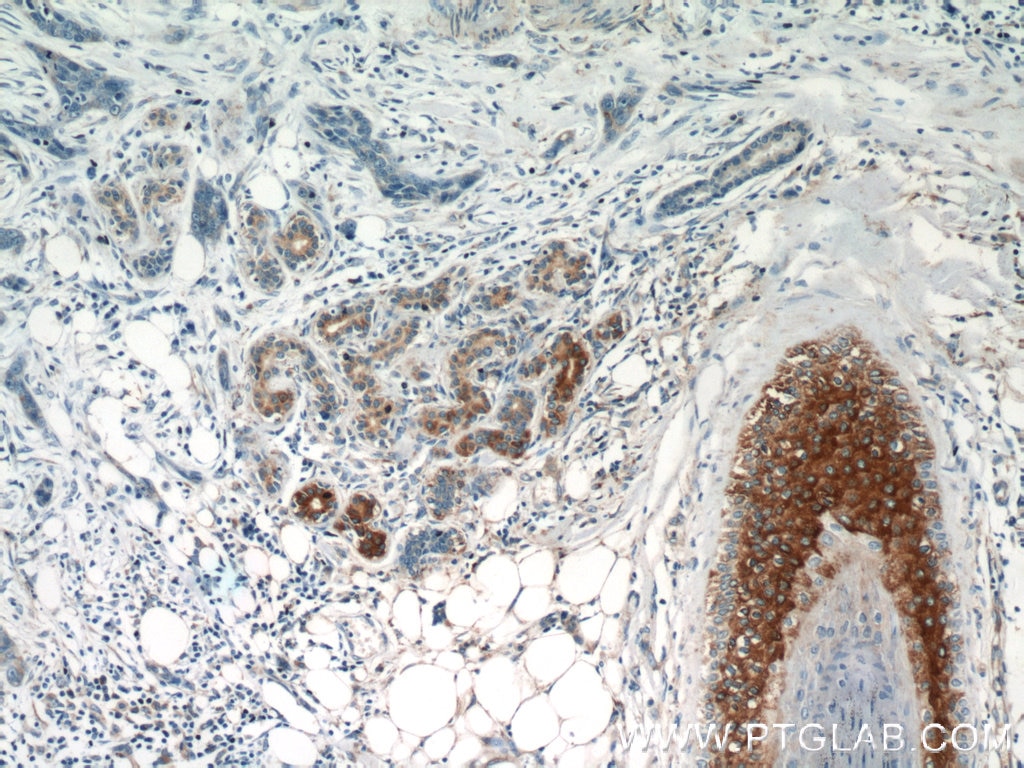 Immunohistochemistry (IHC) staining of human skin cancer tissue using GUSB Polyclonal antibody (16332-1-AP)