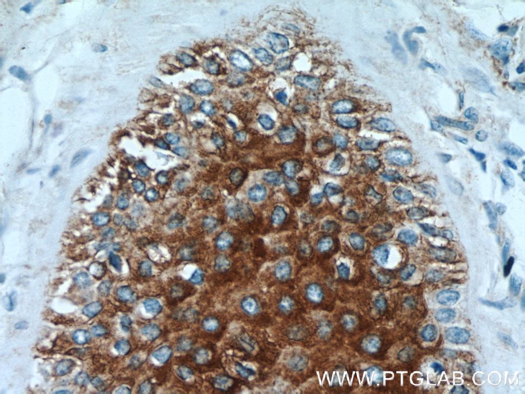 Immunohistochemistry (IHC) staining of human skin cancer tissue using GUSB Polyclonal antibody (16332-1-AP)