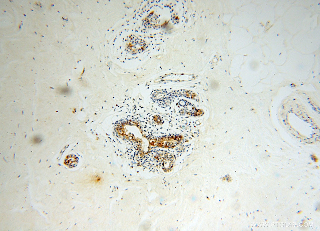 Immunohistochemistry (IHC) staining of human colon cancer tissue using GUSB Polyclonal antibody (16332-1-AP)