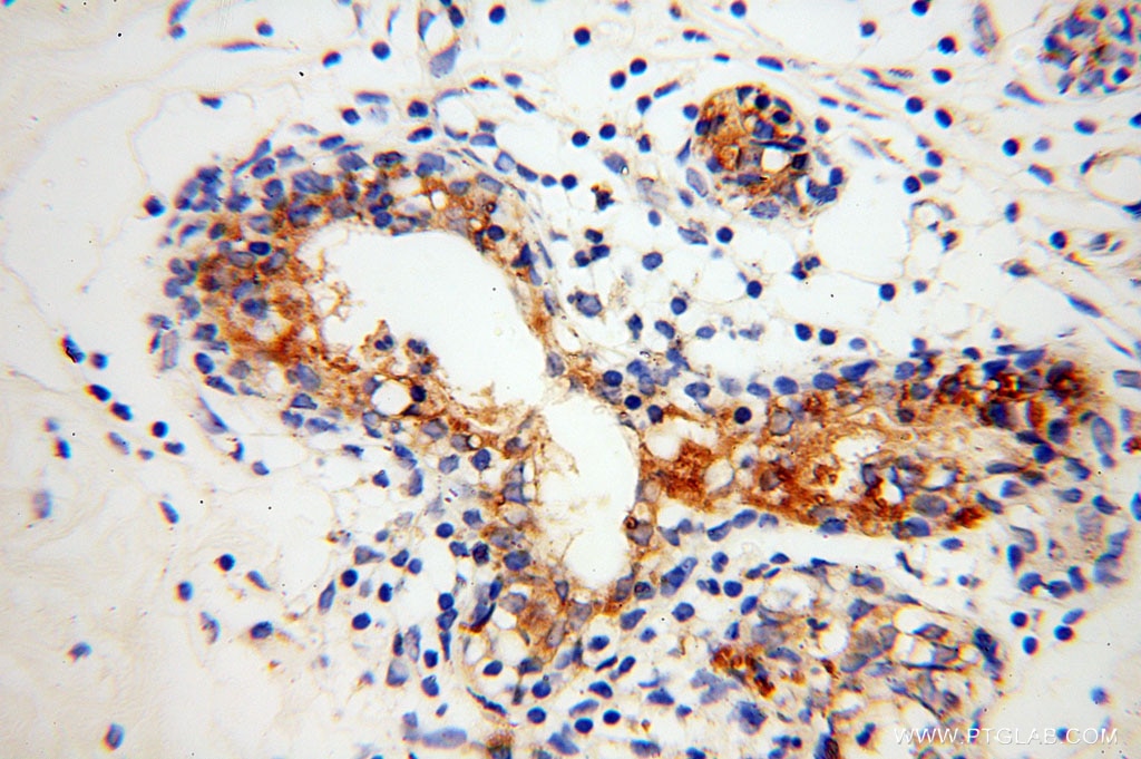 Immunohistochemistry (IHC) staining of human colon cancer tissue using GUSB Polyclonal antibody (16332-1-AP)