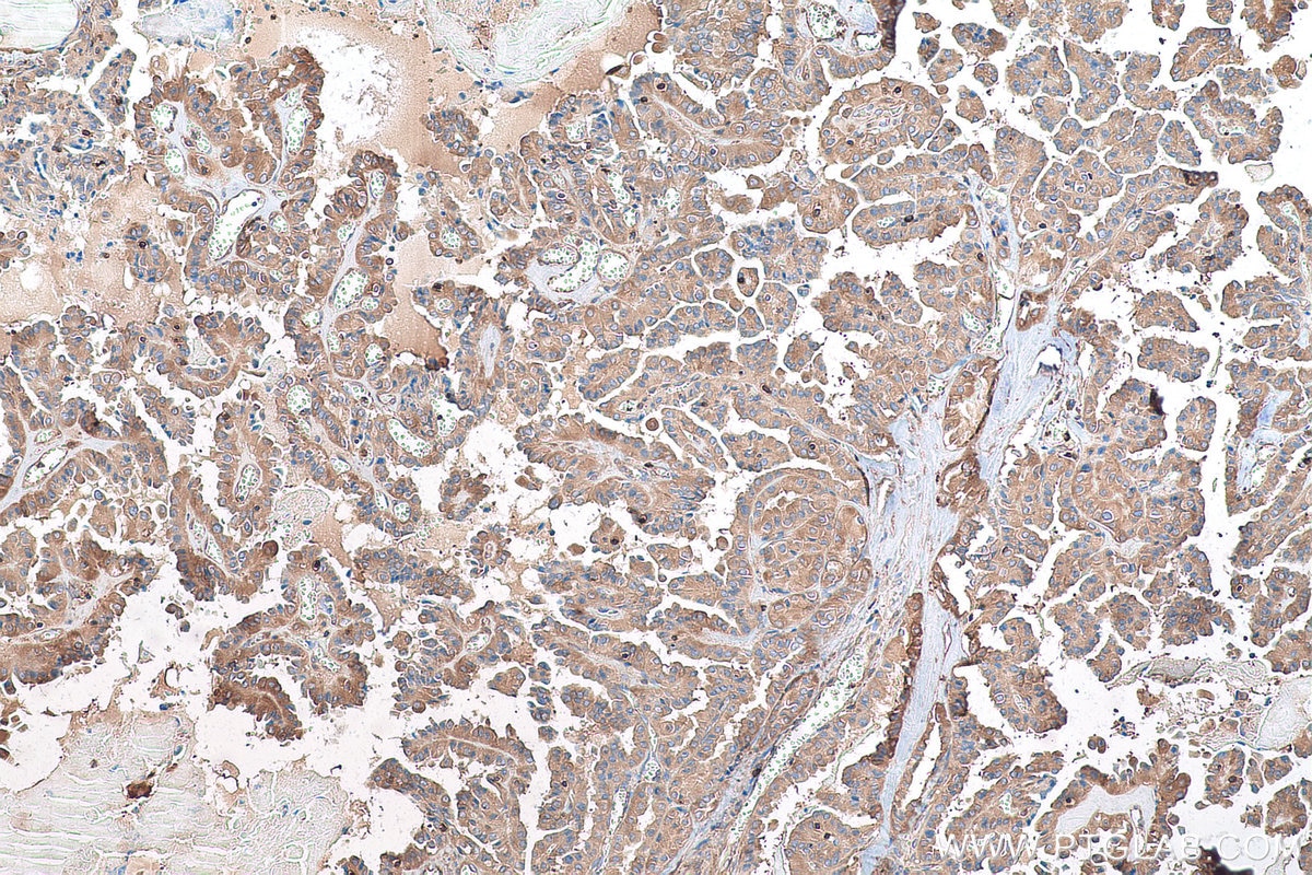 Immunohistochemistry (IHC) staining of human thyroid cancer tissue using GYG1 Polyclonal antibody (12836-1-AP)