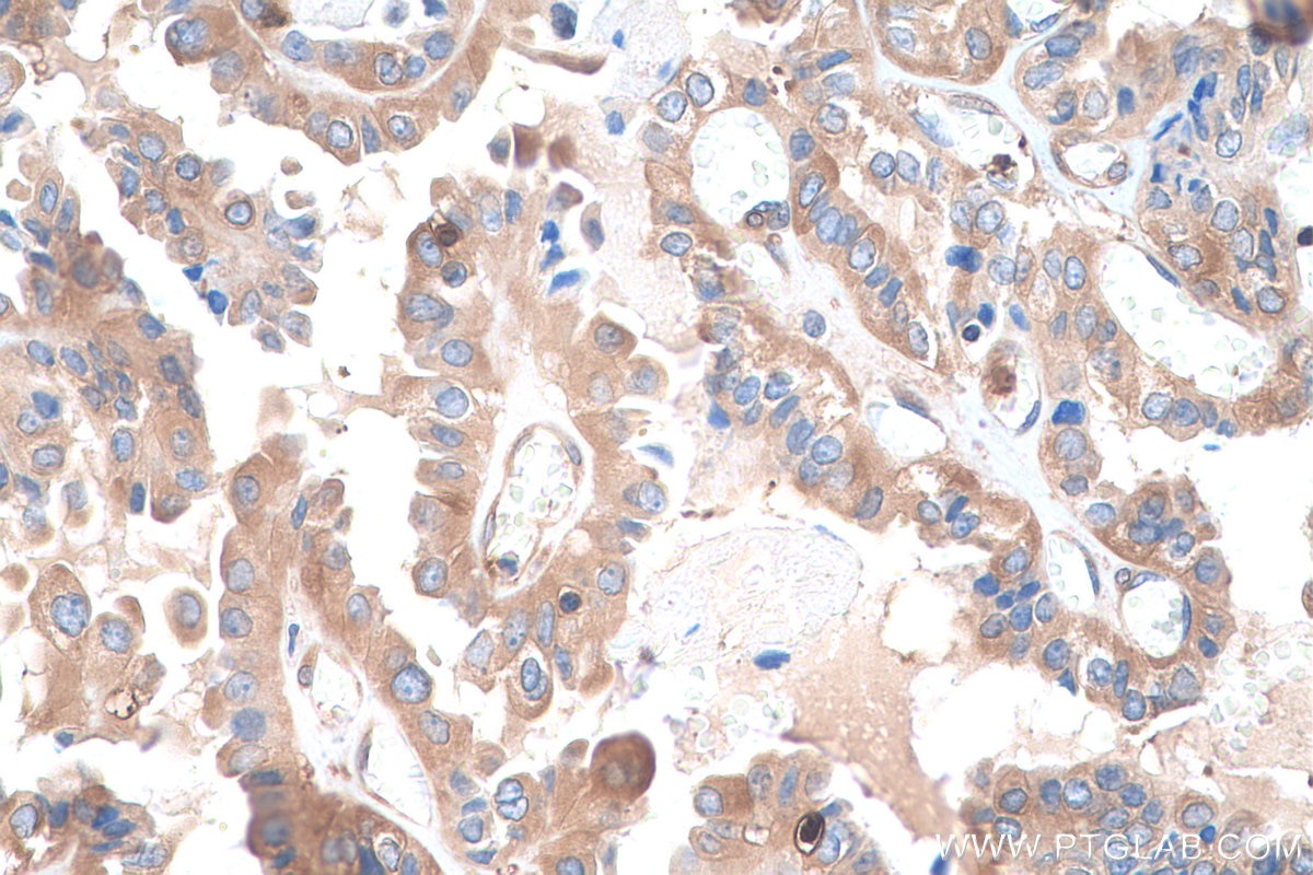 IHC staining of human thyroid cancer using 12836-1-AP