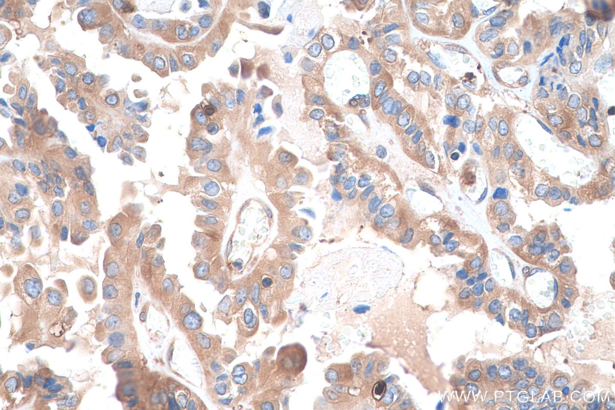 Immunohistochemistry (IHC) staining of human thyroid cancer tissue using GYG1 Polyclonal antibody (12836-1-AP)