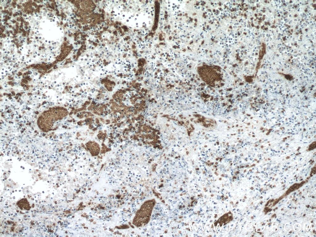 Immunohistochemistry (IHC) staining of human colon cancer tissue using human Glycophorin A Polyclonal antibody (15874-1-AP)