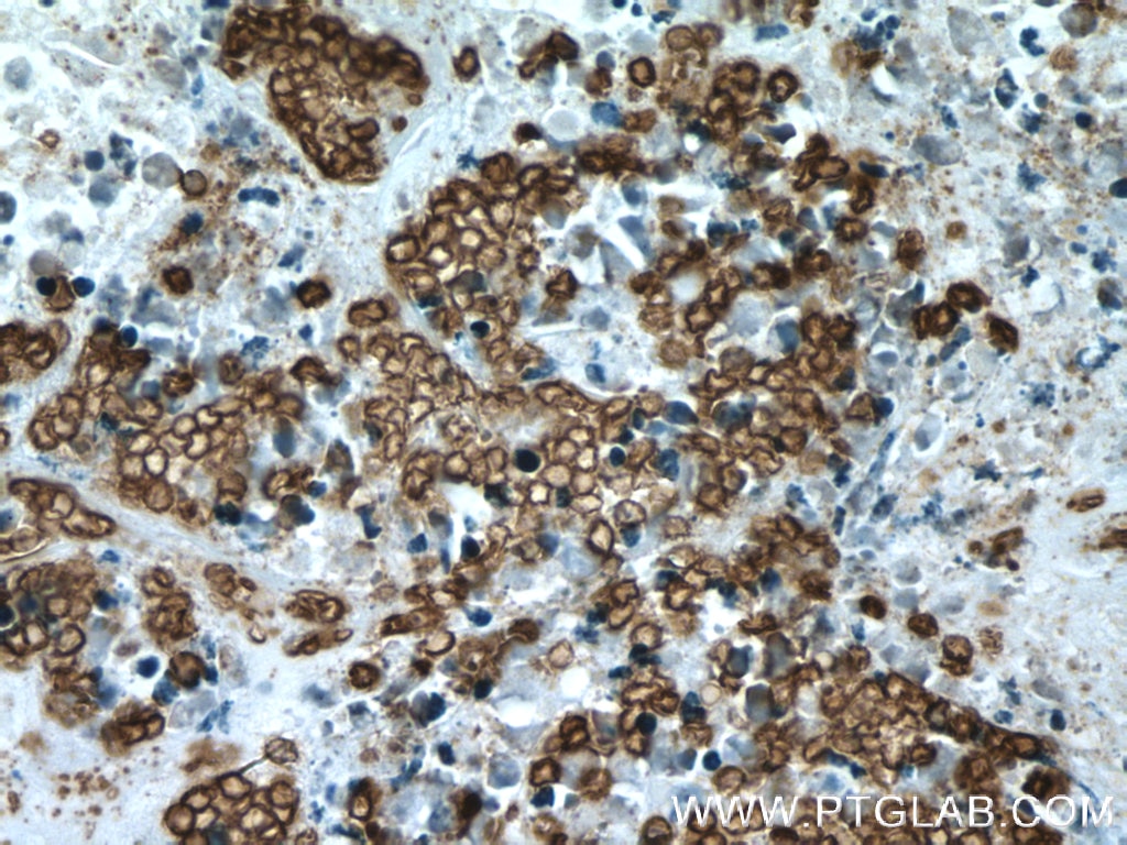 Immunohistochemistry (IHC) staining of human colon cancer tissue using Glycophorin A Polyclonal antibody (15874-1-AP)