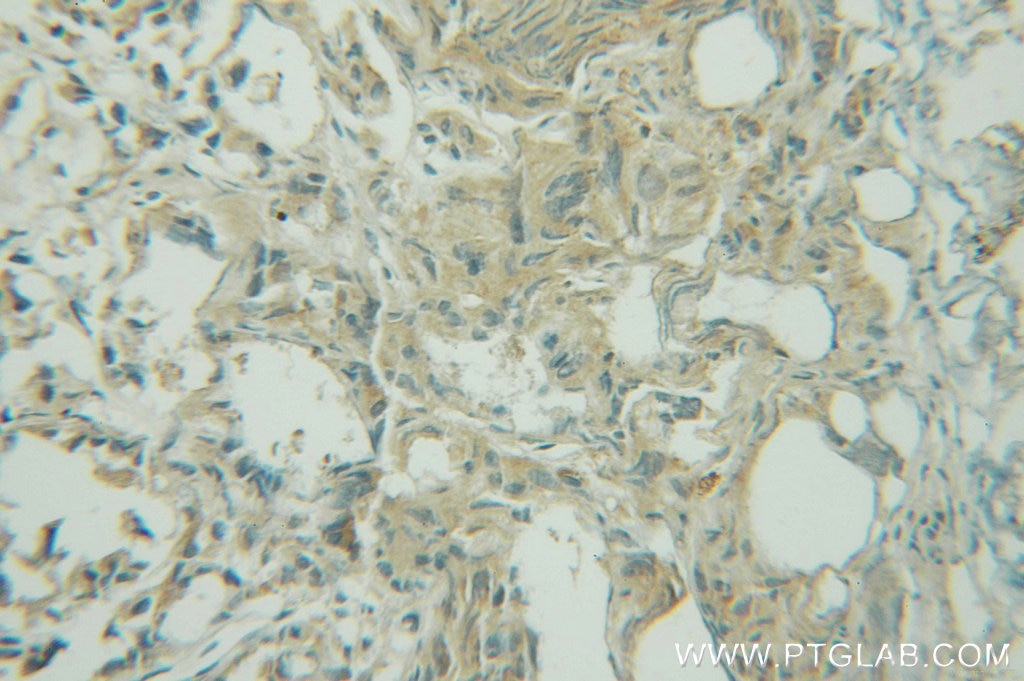 Immunohistochemistry (IHC) staining of human prostate cancer tissue using GYS1 Polyclonal antibody (10566-1-AP)