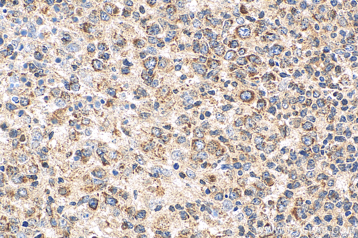 Immunohistochemistry (IHC) staining of human lymphoma tissue using Granzyme A Polyclonal antibody (11288-1-AP)