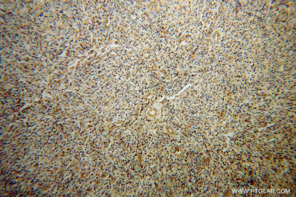 Immunohistochemistry (IHC) staining of human lymphoma tissue using Granzyme A Polyclonal antibody (11288-1-AP)