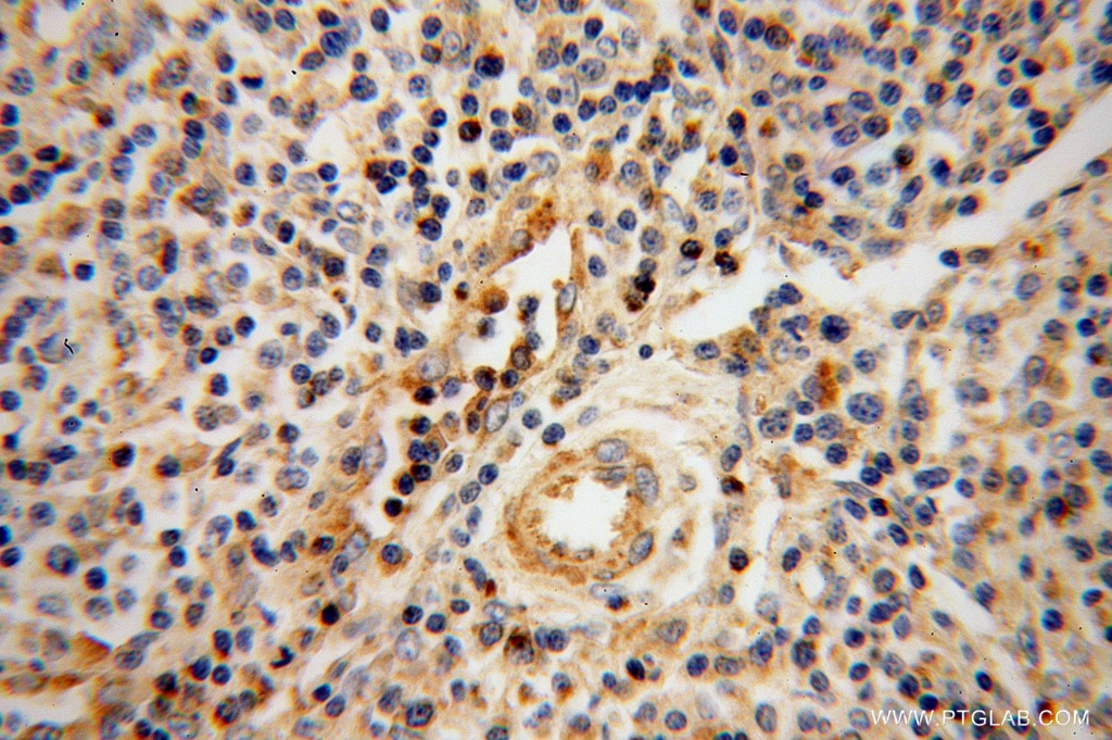 Immunohistochemistry (IHC) staining of human lymphoma tissue using Granzyme A Polyclonal antibody (11288-1-AP)
